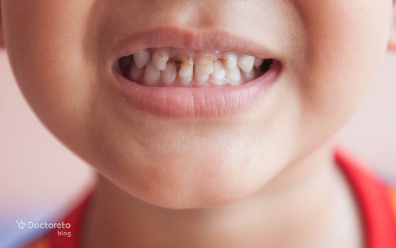 پوسیدگی دندان کودکان چه علتی داشته و چگونه درمان میشود؟